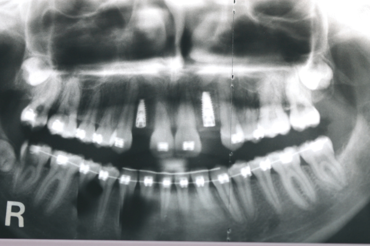 Abb. 13: Postoperatives OPG nach Insertion der beiden Implantate.