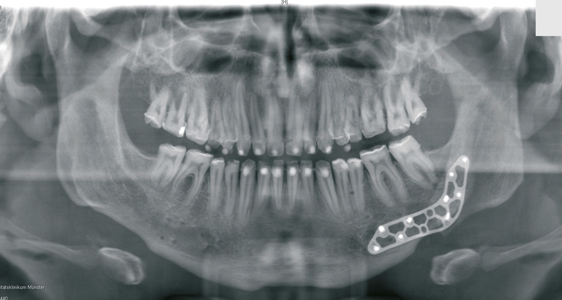 Abb. 11: OPG nach Entfernung der Osteosyntheseplatte im Oberkiefer und rechten Unterkiefer und Neuverplattung im linken Unterkiefer.