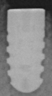 Abb. 15: Implantat regio 33 im Jahr 2013 vor der Eingliederung des Zahnersatzes.