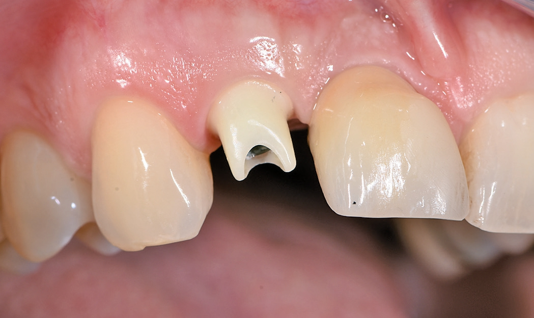 Abb. 11: Ein individuelles Zirkonabutment auf Titanklebebasis wird verwendet.