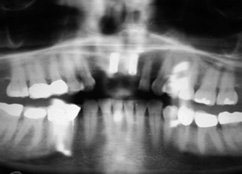 Abb. 11: OPTG zur Kontrolle der Implantatposition.