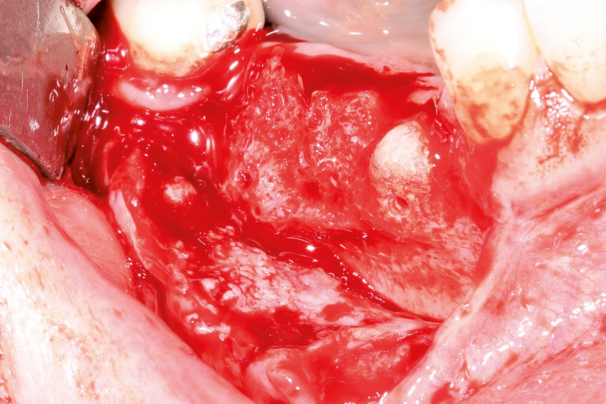Abb. 11b: Intraoperativer Situs nach Entfernung der Osteosyntheseschrauben.