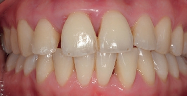 Abb. 7: Intraorale Aufnahme der Front vom 27.06.2018: lokalisiert gerötete und livide geschwollene marginale Gingiva.