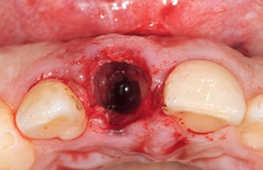 Abb. 10: Die korrekte dreidimensionale Lage des präparierten Implantatbetts ist deutlich zu erkennen.