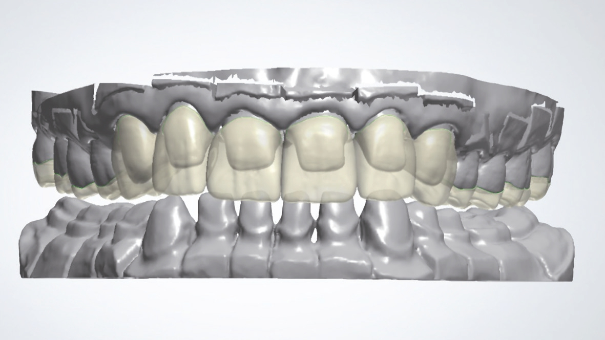 Abb. 7: Präparation und virtuelle Konstruktion (3shape) von Kronen, Teilkronen und Okklusal-Veneers.