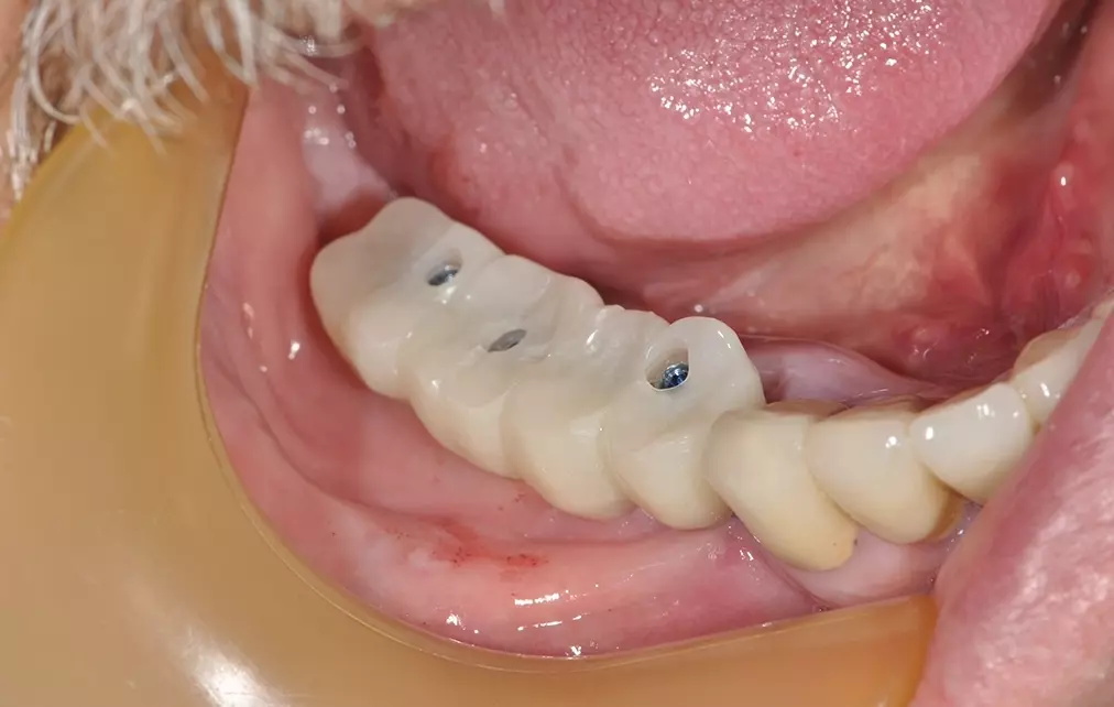 Abb. 12: Mit PMMA-Verblendungsgerüst verklebtes
Metallgerüst.