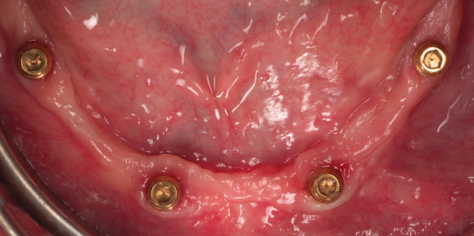 Abb. 13: PS Easy-Con Aufbauten in situ.