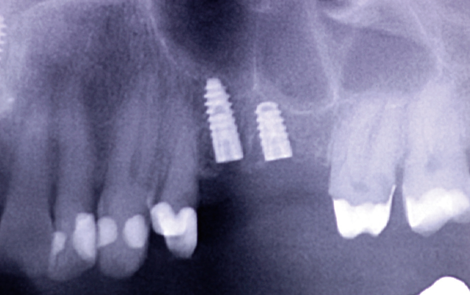 Abb. 12: Panoramaschichtaufnahme nach Implantatinsertion.