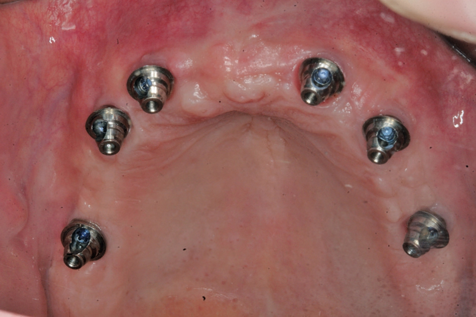 Abb. 12: Verschraubte Abutments zur Aufnahme der axial verschraubten zirkulären Brücke.