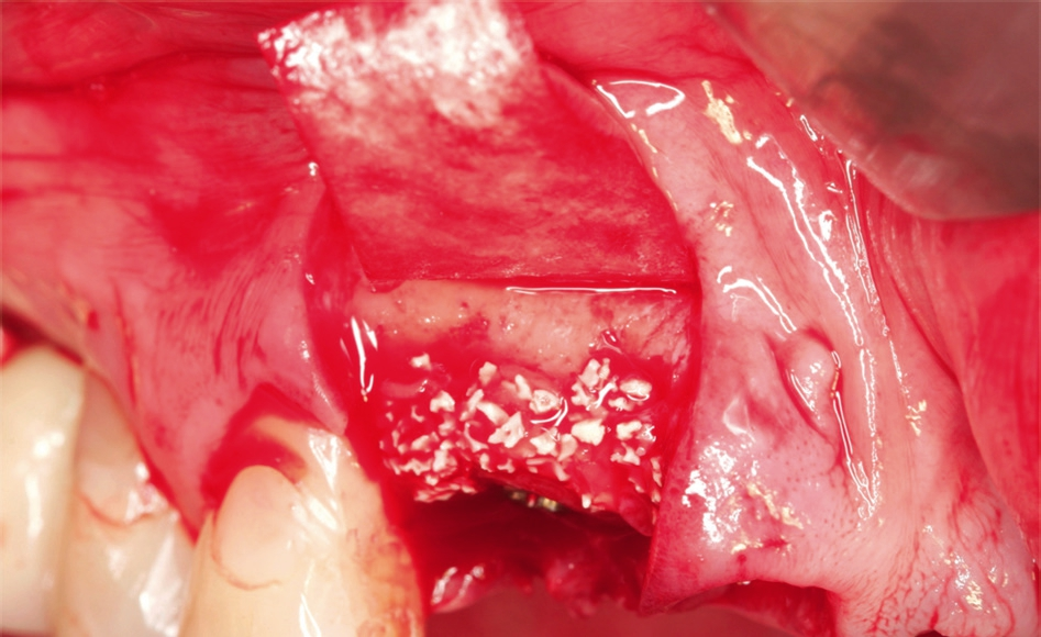 Abb. 11: Überschichten des Defektes mit cerabone® und Jason® membrane als Resorptionsschutz.