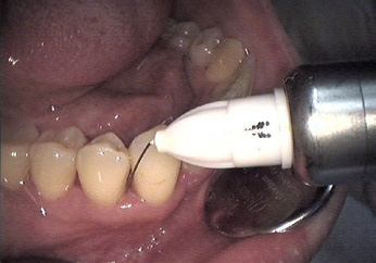 Abb. 5: Dosierradspritze in situ – der Gingivalsaum zeigt eine deutliche Ischämie.