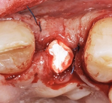 Abb. 12: Der gingivale Defektbereich wurde mit einem Kollagenkegel verschlossen.