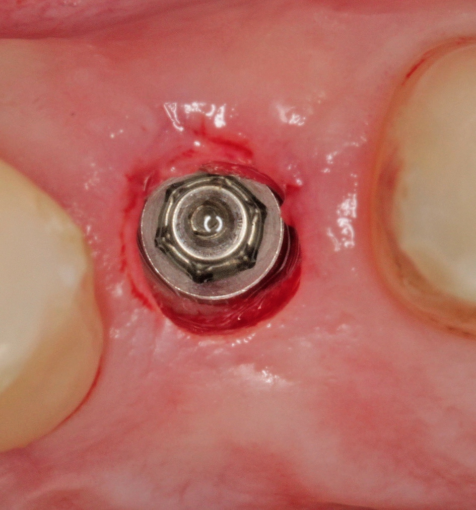 Abb. 12: Implantat in situ.