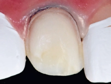 Abb. 12: Isolierung der Nachbarzähne mit Teflonband.
