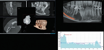 Abb. 15: MPR, PAN Detail, Histogramm, unizystisches Ameloblastom.