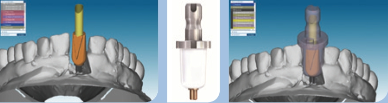 Abb. 14–16: Matchen des Scan-Abutments mit dem Schleifkörper.