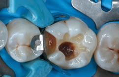 Abb. 12: Nach dem Auftragen des Adhäsivs zeigt die versiegelte Kavität in allen Bereichen eine glänzende Oberfläche.