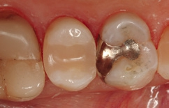 Abb. 12: Dichte, adhäsive präendodontologische Aufbaufüllung aus zwei horizontalen Inkrementen eines Bulk-Flow-Komposites.