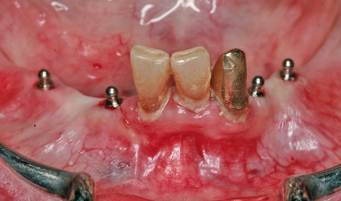 Abb. 12: Vier Mini-Implantate CITO mini® in situ.