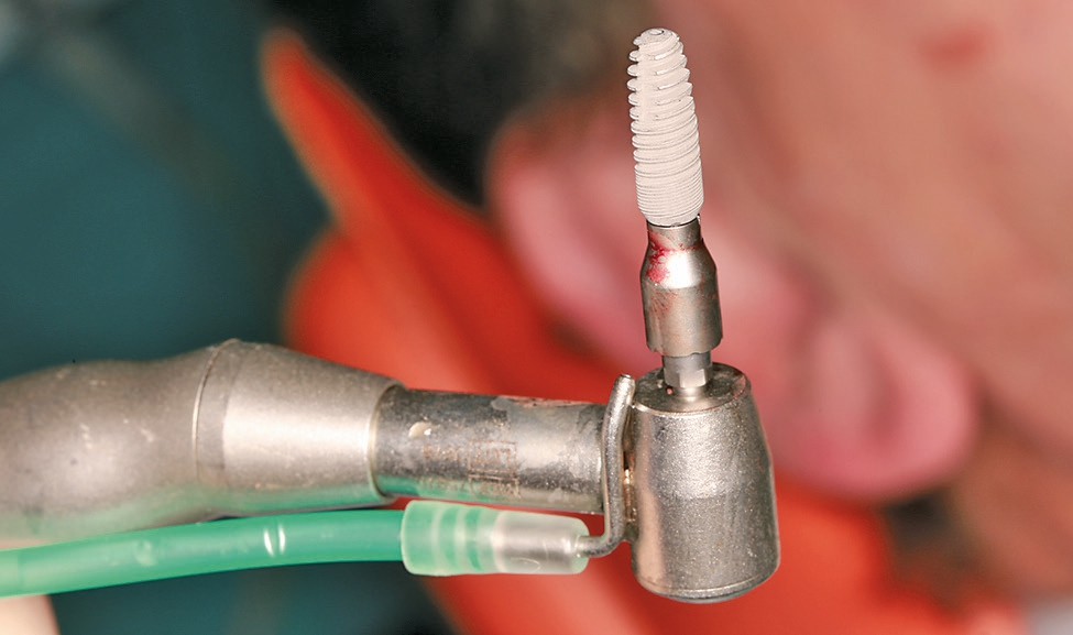 Abb. 12: Implantat auf Einbringhilfe fertig zum Implantieren.