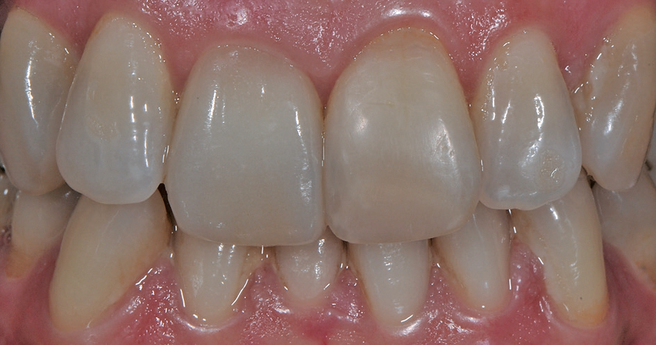 Abb. 12: Situation nach der Eingliederung der Veneers auf den Zähnen 11 und 13.