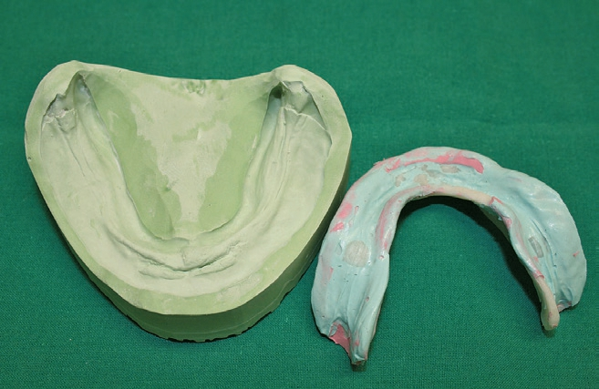 Abb. 7: Abformung und Arbeitsmodell für die TUK ...