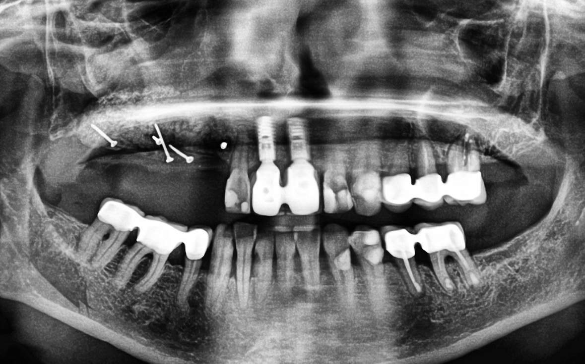 Abb. 12: Das postoperative Röntgenbild zeigt deutlich die Knochenentnahmestelle im 4. Quadranten und den augmentierten Bereich.