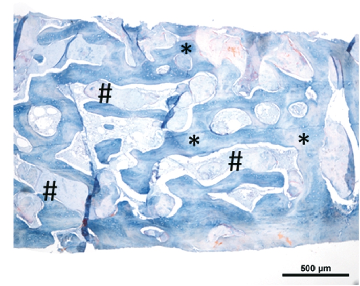 Abb. 12: Histologie: Die histologische Untersuchung zeigt die Integration des partikulären Biomaterials in der Augmentationsregion. Es bildet sich eine Kombination aus neugebildeten Knochen (*) um die eingebauten Partikel des Knochenersatzmaterials (#) und das gefäßreiche blutführende Bindegewebe.