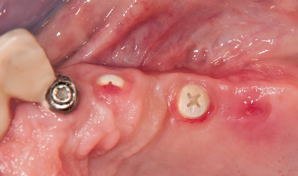 Abb. 12: Eingeheilte Implantate nach drei Monaten.