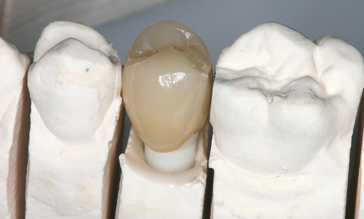 Abb. 12: Zur Versorgung des Implantats wurde eine Glaskeramikkrone CAD/CAM-gestützt hergestellt.