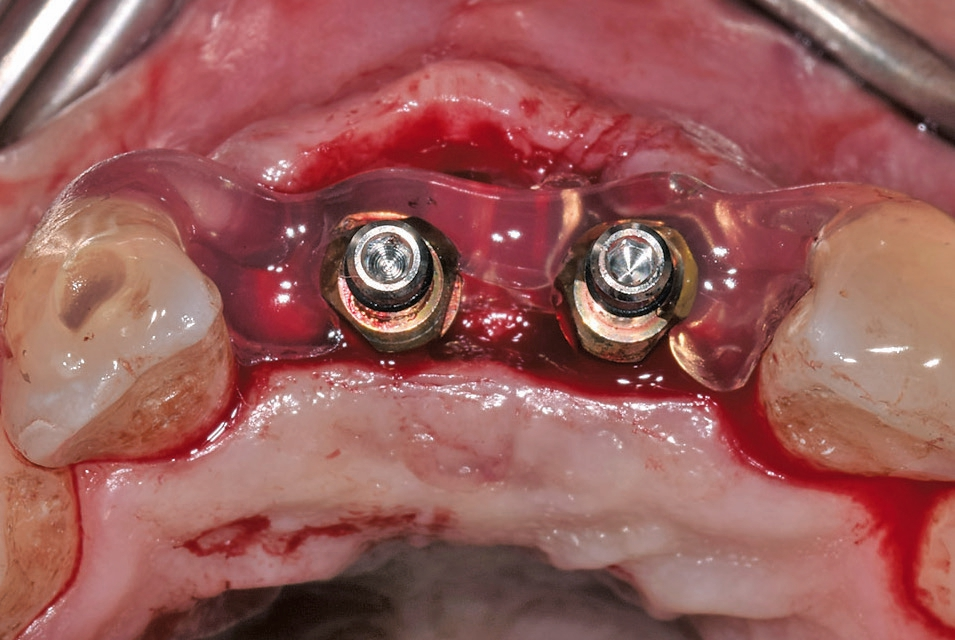 Abb. 12: Indexierung der Implantatposition. Abb. 13: Klinische Situation der geschlossenen Schleimhaut sieben Tage nach Implantation.