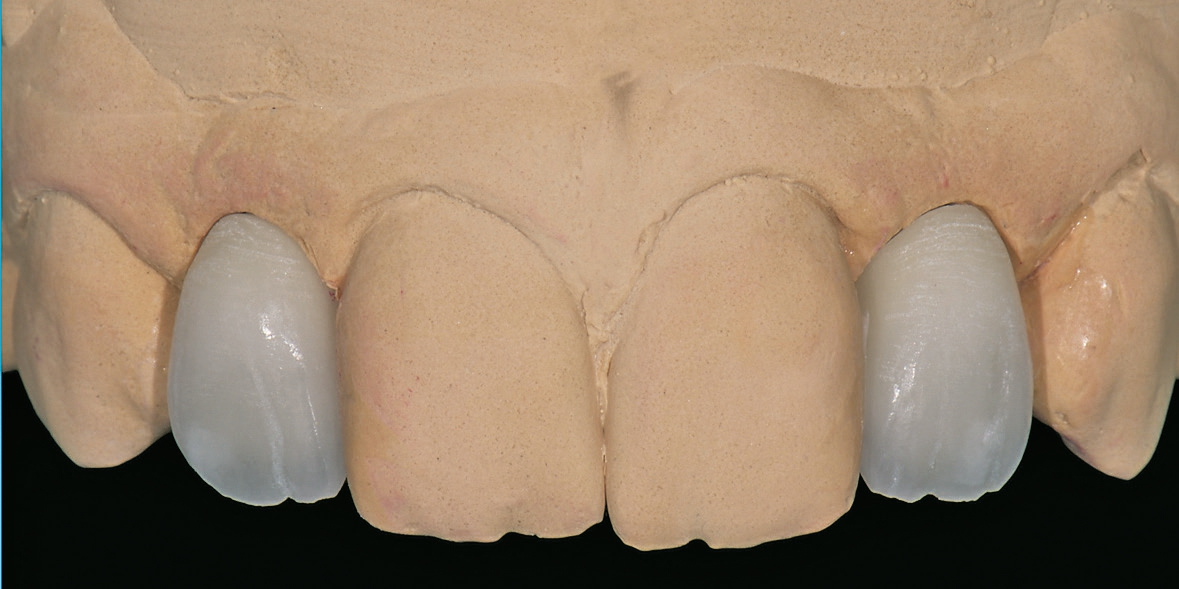 Abb. 12: Ergebnis nach dem Korrekturbrand und zum Glanzbrand vorbereitet.