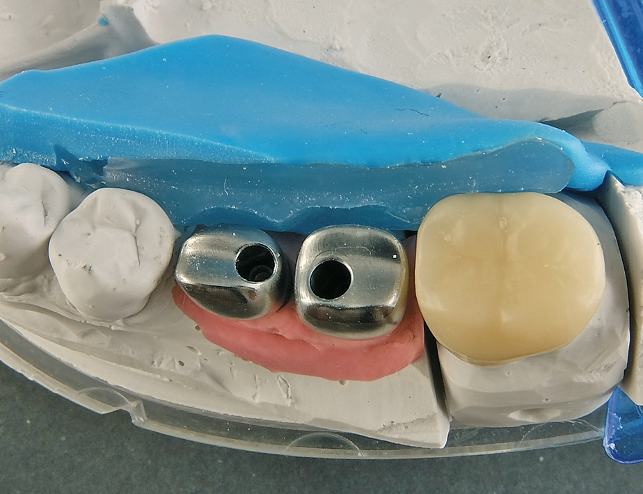 Abb. 36: Mithilfe von individuell gefertigten Abutments konnte trotz einer nicht völlig optimalen Ausgangssituation eine gute Lösung gefunden werden.
