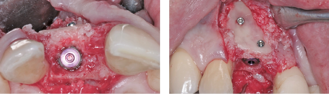 Abb. 12 und 13: Die Fixierung der Knochenschalen erfolgte von bukkal mittels Osteosyntheseschrauben in regio 11.