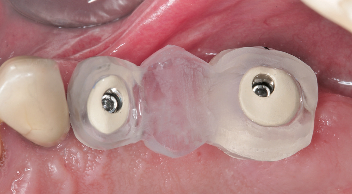 Abb. 14: Einbringhilfe für die korrekte Ausrichtung der definitiven Abutments.