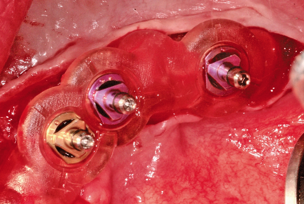 Abb. 12: Schablone mit inserierten Implantaten im Unterkiefer.