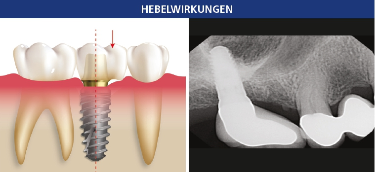 Abb. 7a: Mesiale und distale Hebel entstehen bei nicht idealer Implantatplatzierung oder durch überkonturierte Kronen, was zu Kräfteversatz und Hygieneproblemen führt. Abb. 7b: In diesem Beispiel einer nicht idealen posterioren Insertion ist das Implantat zu weit von den benachbarten natürlichen Zähnen entfernt, was zu einem großen mesialen Hebel führt. Die sich daraus ergebenden Scherkräfte werden mit größter Wahrscheinlichkeit zu krestalem Knochenverlust oder dem Versagen einer Komponente führen.