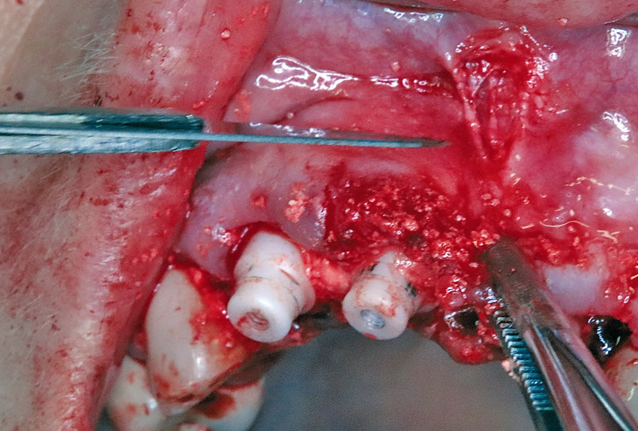 Abb. 13: Entlastung des Lippenbändchens.