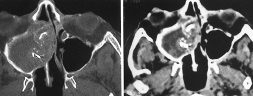 Abb. 10: Massive Pilzkugelformation in der rechten Kieferhöhle. Die Aufhellungen sind charakteristische radiologische Zeichen für Kalkeinlagerungen in den Wandungen von Pilzhyphen.