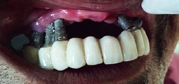 Abb. 8: Extreme Periimplantitis verursacht Mundgeruch.