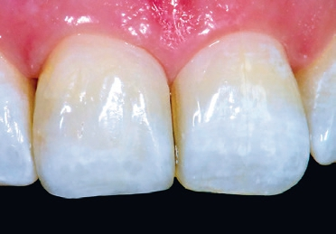 Abb. 12: Ergebnis: Zur finalen Farbanpassung konnte die wolkige Struktur nach weiterer Konditionierung mit AL(2)O(3) und nach bereits beschriebenen Kriterien (einer Mischung aus BXL, Baseliner und CL-clear, Venus Diamond, Kulzer) angefertigt werden. Die Mischung wurde direkt auf der Zahnoberfläche vorgenommen. So konnten Bereiche mit geringerer oder intensiverer Einfärbung als auch Bereiche mit transluzenterer Eigenschaft gestaltet werden.