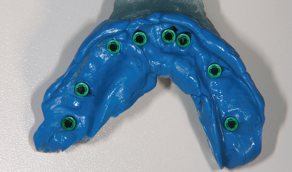 Abb. 12: Nach Abformung gingivale Ansicht der Abdruckpfosten.