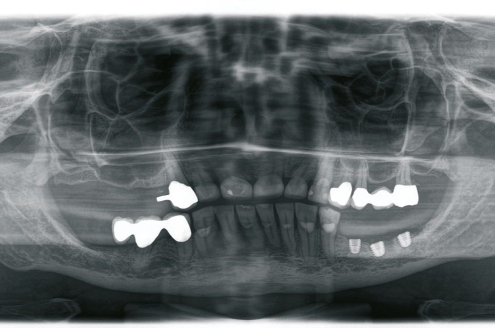 Abb. 12: Postoperative Kontrolle nach Insertion der Implantate.