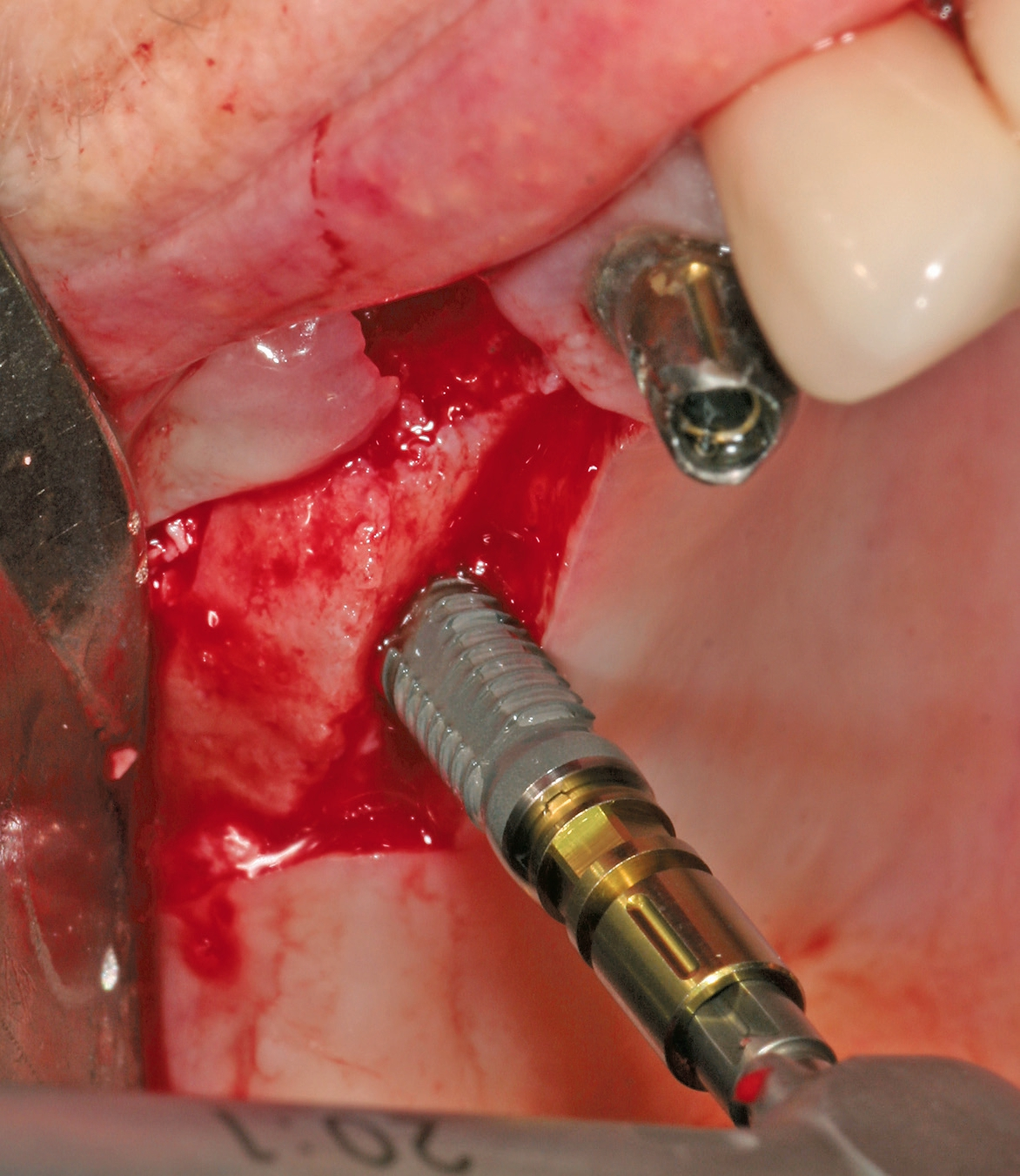Abb. 12: Implantatinsertion nach Sinuslift.