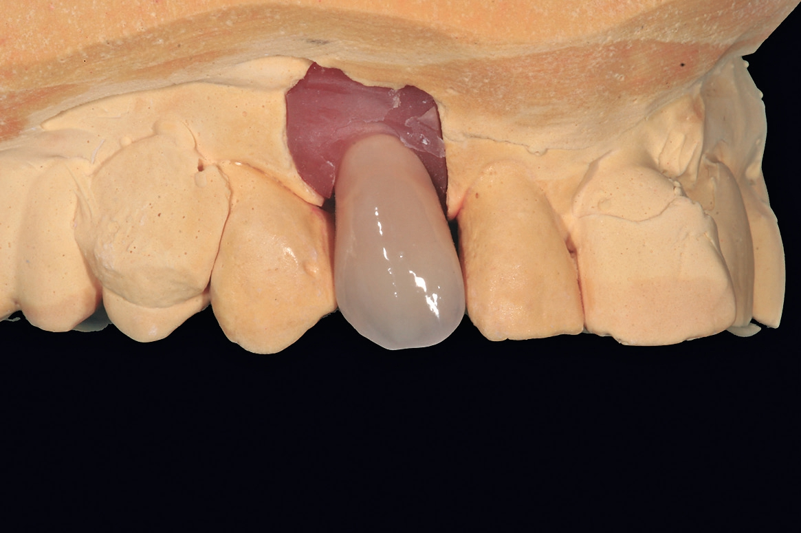 Abb. 12: Die im Labor erstellte vollkeramische Implantatkrone.