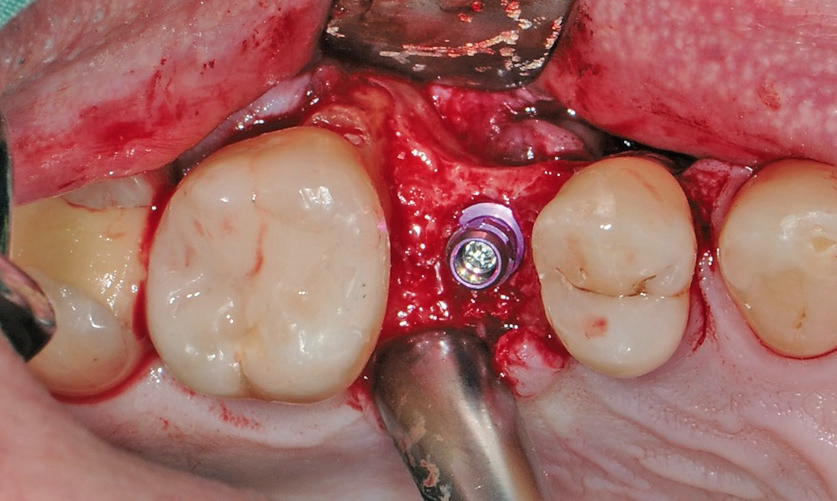 Abb. 11: Implantat in situ mit Verschlussschraube.