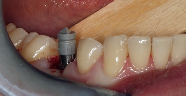 Abb. 12: Scanbody für die Übertragung der Implantatposition.