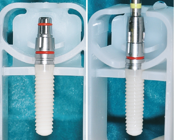 Abb. 12: Die positionierte Eindrehkappe und die Entnahme des ceramic.implant.