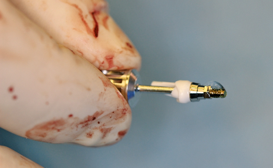 Abb. 12: Megagen Fuse Abutments mit CHX-Gel.