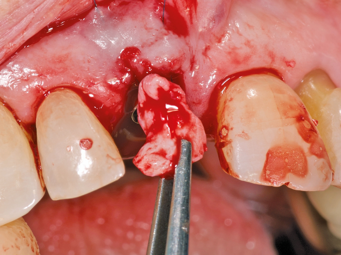 Abb. 15: Freies Bindegewebetransplantat.